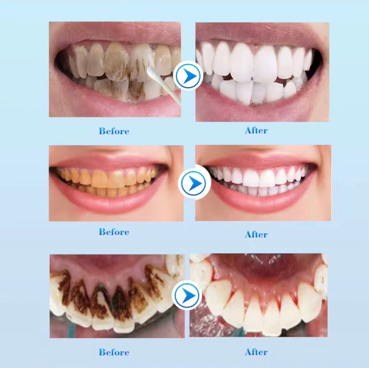 EFEERO Blanchiment dentaire 🦷