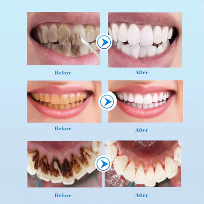 EFEERO Blanchiment dentaire 🦷