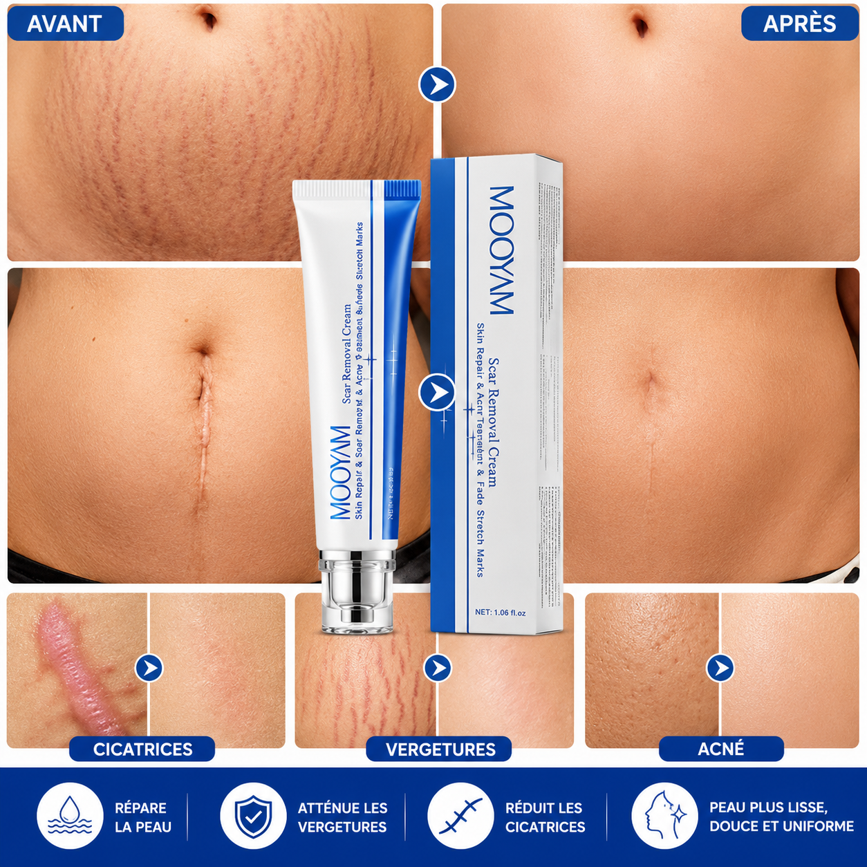Crème Anti-vergetures & cicatrices – Retrouve une peau lisse et uniforme