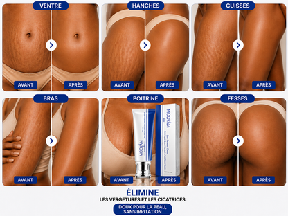Crème Anti-vergetures & cicatrices – Retrouve une peau lisse et uniforme