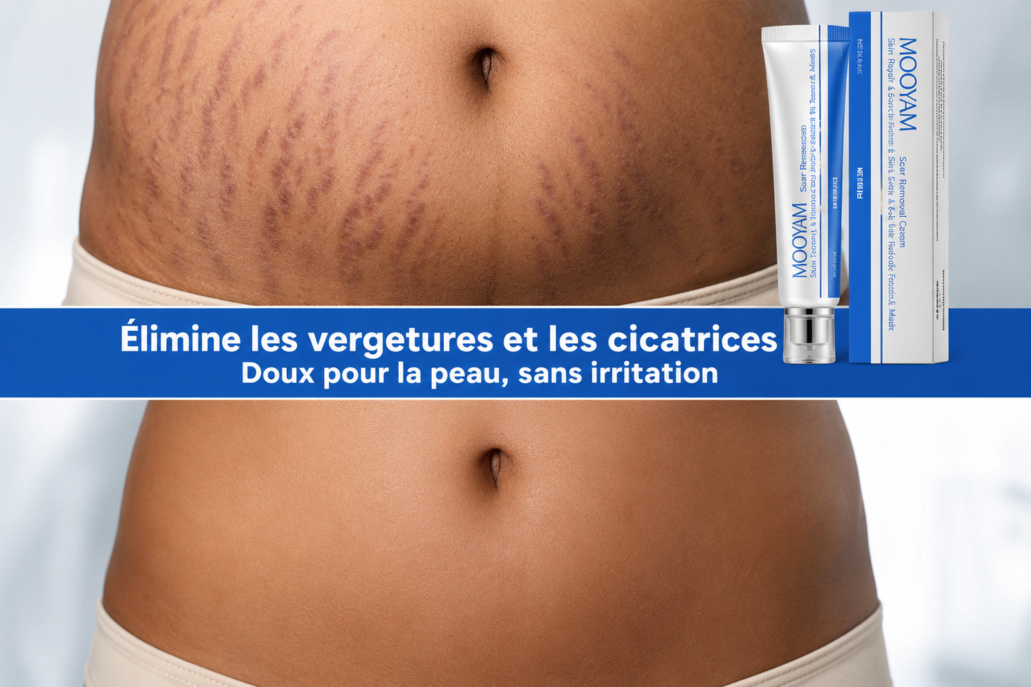 Crème Anti-vergetures & cicatrices – Retrouve une peau lisse et uniforme