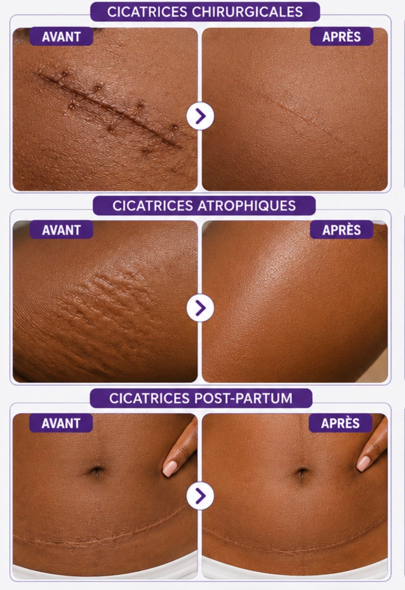 Crème Anti-vergetures & cicatrices – Retrouve une peau lisse et uniforme