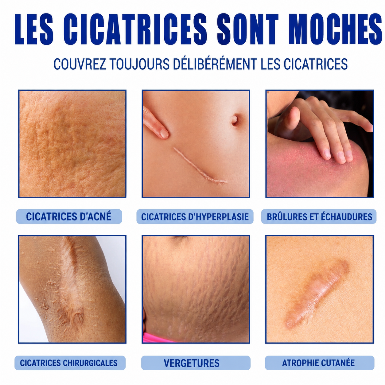Crème Anti-vergetures & cicatrices – Retrouve une peau lisse et uniforme