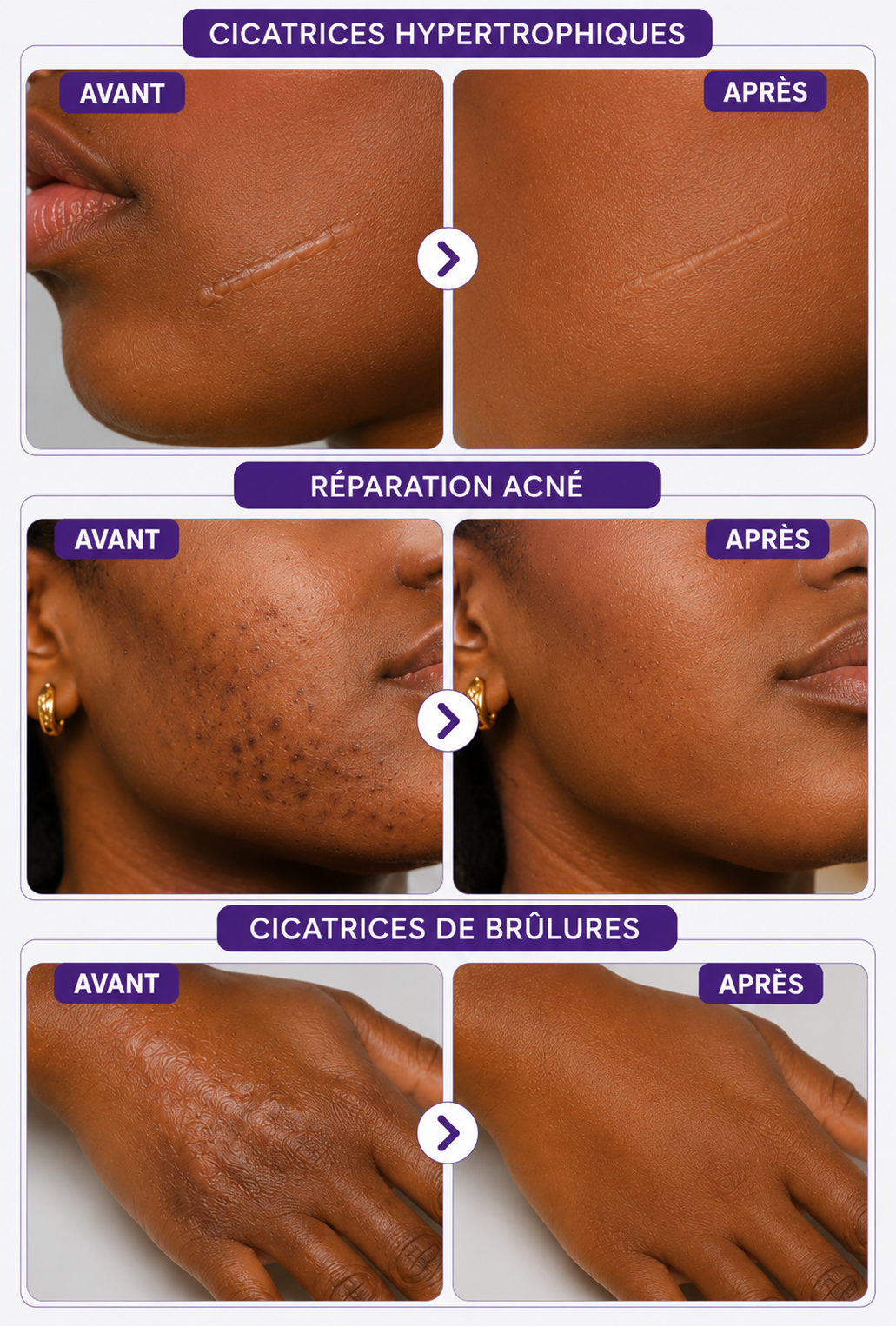 Crème Anti-vergetures & cicatrices – Retrouve une peau lisse et uniforme