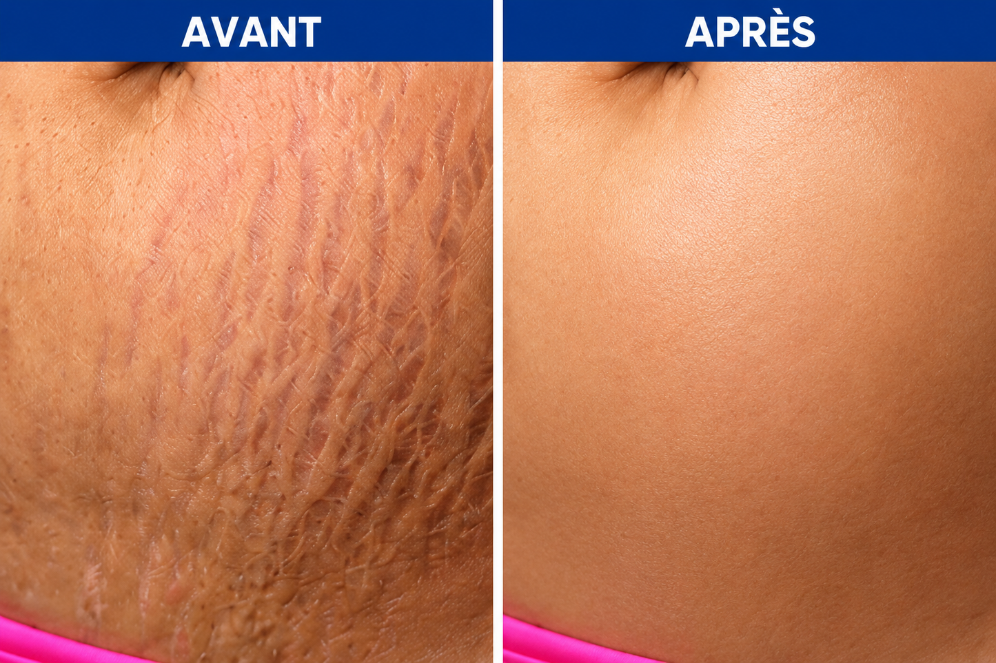 Crème Anti-vergetures & cicatrices – Retrouve une peau lisse et uniforme