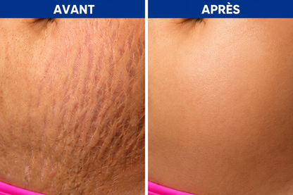 Crème Anti-vergetures & cicatrices – Retrouve une peau lisse et uniforme